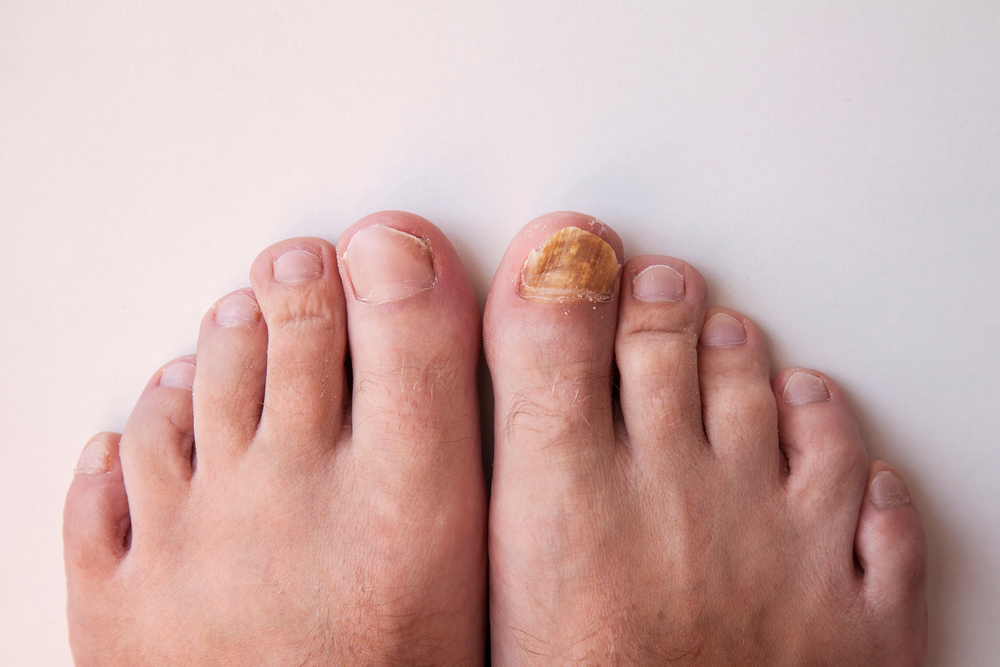 Желтые ногти – причины, симптомы, виды, диагностика и лечение | «Будь Здоров»