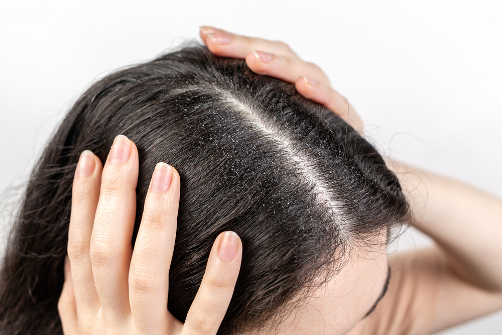 Лечение болячек и ранок на коже головы — Причины появления корок в волосах - Клиника «Доктор Волос»