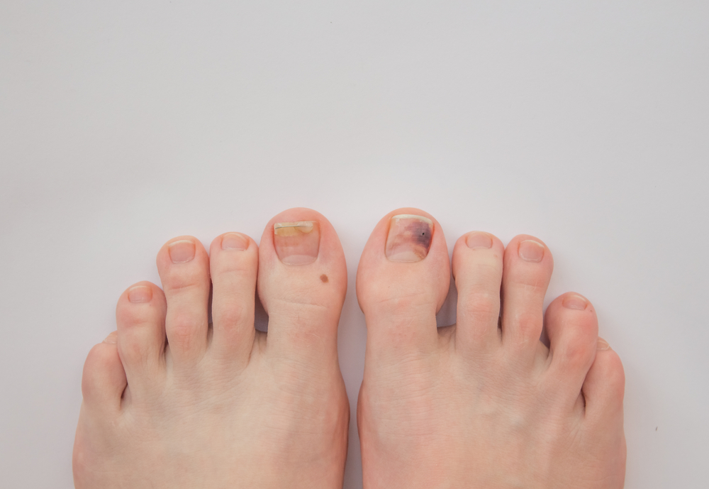 Красные пятна на ногах при сахарном диабете - причины, лечение